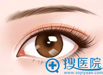 重睑修复 重睑修复