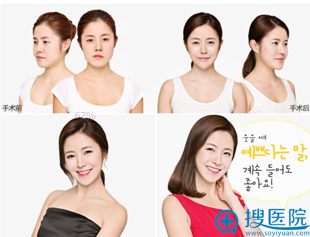 ����Smile�������ҽԺ˫��Ƥ+�Ǽ�+ȫ��֬����䰸��