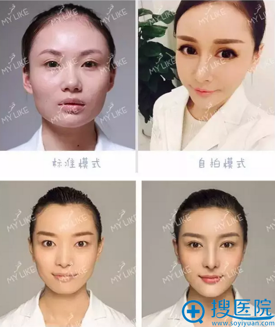 四川美莱双眼皮+开眼角整形案例 四川美莱双眼皮+开眼角整形案例