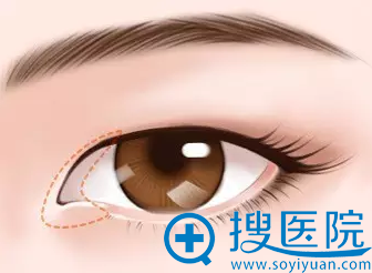 开眼角 开眼角