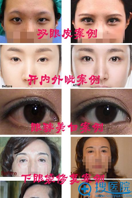 刘辅蓉显微眼整形案例效果图 刘辅蓉显微眼整形案例效果图