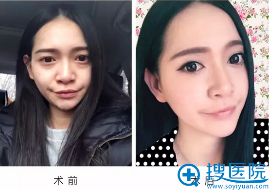 甩一张祛眼袋前后照片刺激你们,哈哈 甩一张祛眼袋前后照片刺激你们,哈哈