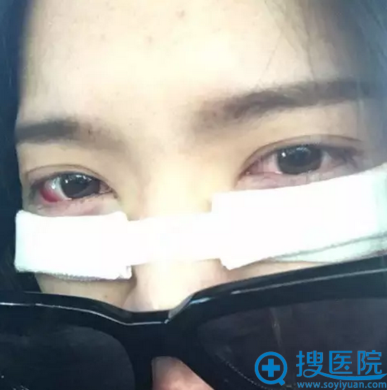 我在暗示吃消炎药,术后天的样子 我在暗示吃消炎药,术后天的样子