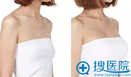 谭晓燕平面丰胸案例效果图 谭晓燕平面丰胸案例效果图