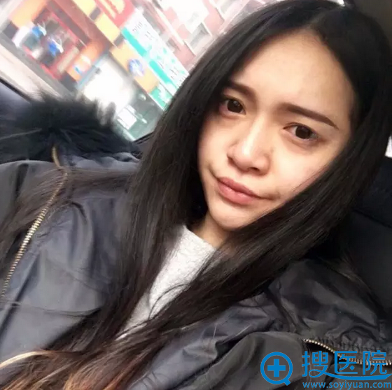 看我在福州名韩整形医院花了2800元祛眼袋的效果怎么样 看我在福州名韩整形医院花了2800元祛眼袋的效果怎么样