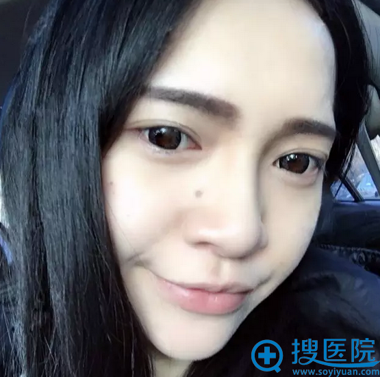 祛眼袋三周后,拍照再也不用p眼袋了 祛眼袋三周后,拍照再也不用p眼袋了
