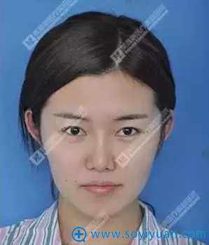 北京美雅枫面部线雕提升真人案例 术后接工作到手软