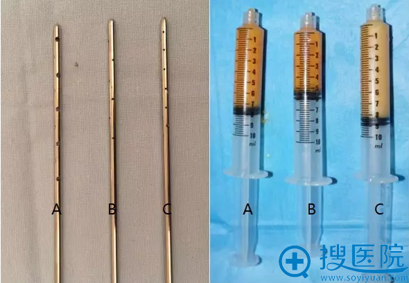 使用不同孔径的吸脂器套针和脂肪 使用不同孔径的吸脂器套针和脂肪