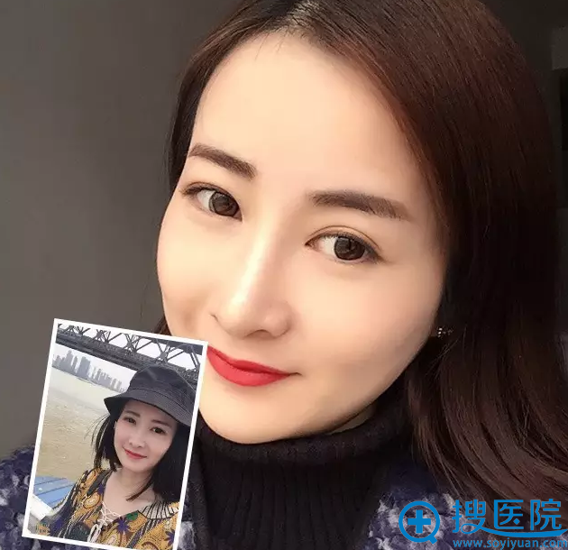 武汉新至美谭式4D隐形隆鼻真人案例 一步晋级成女神