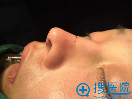 手术完朝天鼻消失 手术完朝天鼻消失