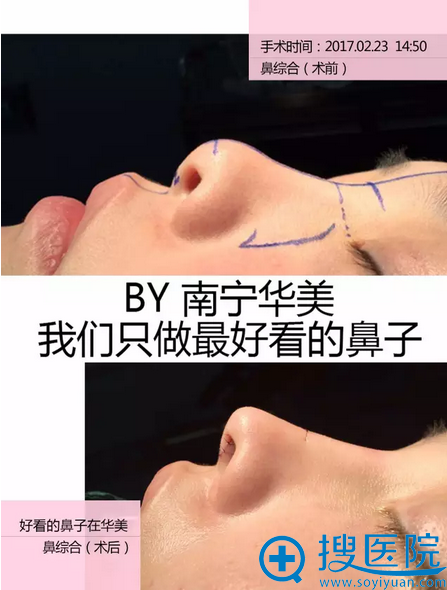 膨体隆鼻术前术后对比照片 膨体隆鼻术前术后对比照片