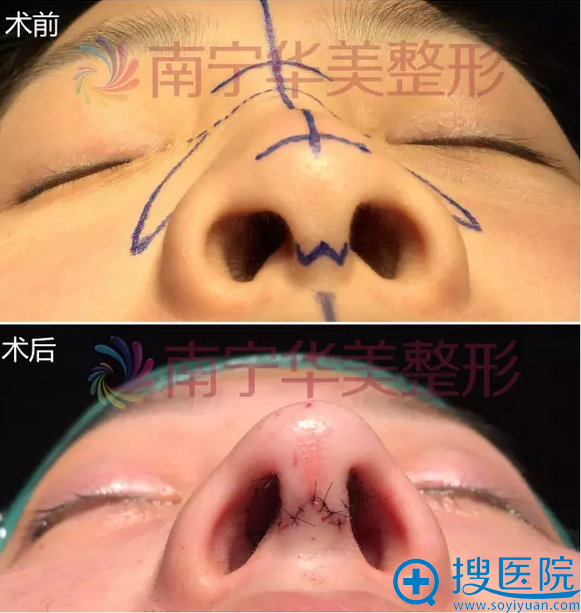 膨体隆鼻即刻效果 膨体隆鼻即刻效果