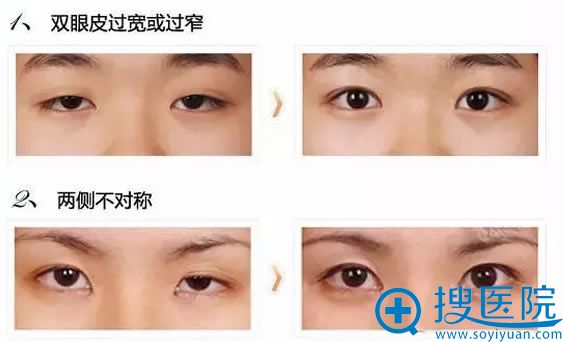 双眼皮失败案例效果图 双眼皮失败案例效果图