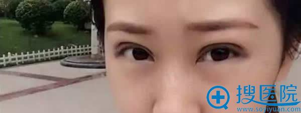 双眼皮术后30天效果图 双眼皮术后30天效果图