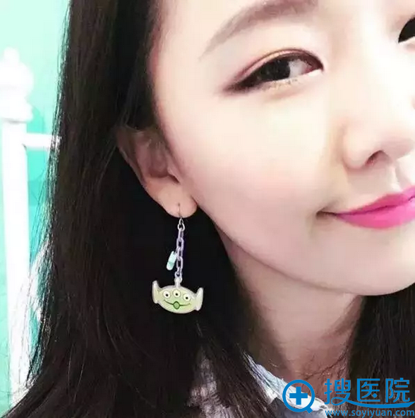 双眼皮手术第七天,是不是超自然啊 双眼皮手术第七天,是不是超自然啊