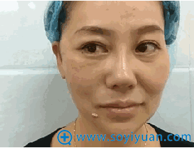 谢双灵教授面部埋线提升术半边脸对比效果 谢双灵教授面部埋线提升术半边脸对比效果