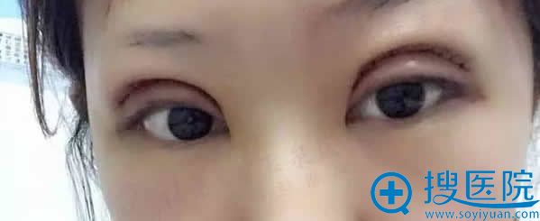 双眼皮手术后3天正常症状 双眼皮手术后3天正常症状