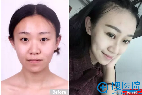 上海华美改善眼裂狭窄案例 上海华美改善眼裂狭窄案例