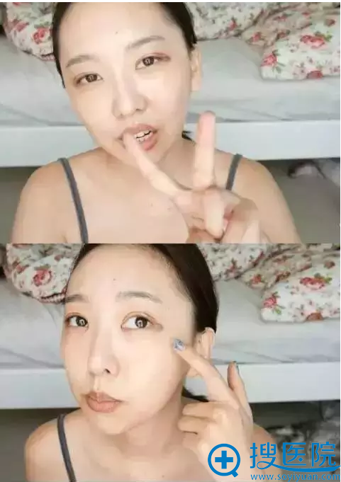 双眼皮手术第二天,消肿还不错 双眼皮手术第二天,消肿还不错