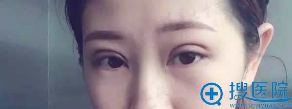 双眼皮9天后正常症状表现 双眼皮9天后正常症状表现