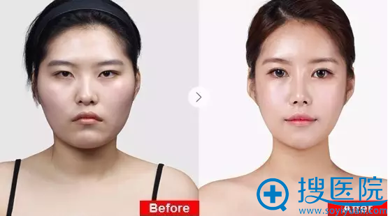上海华美改善肿泡眼双眼皮手术案例 上海华美改善肿泡眼双眼皮手术案例