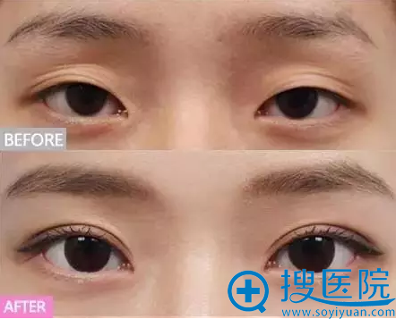 <!--<i data=20240710 data-id=15924></i>-->医院双眼皮修复案例 <!--<i data=20240710 data-id=15924></i>-->医院双眼皮修复案例