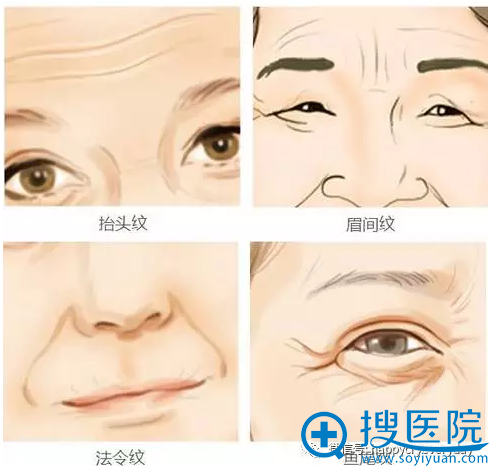 当你出现眼角下垂、嘴角下垂、脸颊下垂、鼻唇沟明显、双下巴明显时说明需要做埋线提升 当你出现眼角下垂、嘴角下垂、脸颊下垂、鼻唇沟明显、双下巴明显时说明需要做埋线提升
