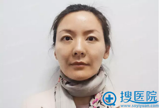 【视频】我在江苏施尔美整形医院做面部悬吊提升手术的亲身经历