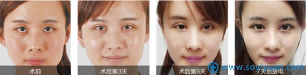 <!--<i data=20240710 data-id=14448></i>-->灵韵大眼术蜕变过程 <!--<i data=20240710 data-id=14448></i>-->灵韵大眼术蜕变过程