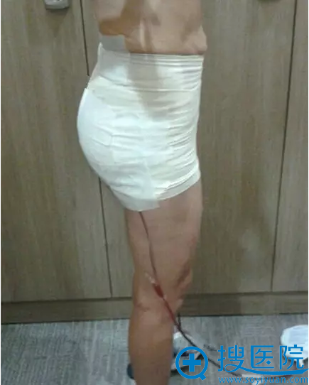 自体脂肪丰臀也配有血袋 自体脂肪丰臀也配有血袋