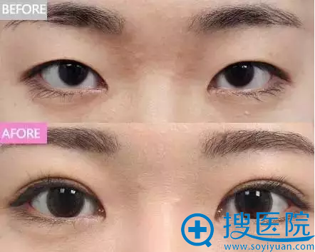 上海华美轻度倒睫前后对比照片 上海华美轻度倒睫前后对比照片