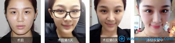 <!--<i data=20240710 data-id=14448></i>-->双眼皮手术蜕变过程 <!--<i data=20240710 data-id=14448></i>-->双眼皮手术蜕变过程