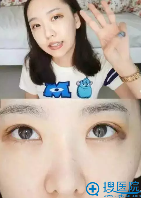 双眼皮手术第三天,淤青就想打了眼影一样 双眼皮手术第三天,淤青就想打了眼影一样