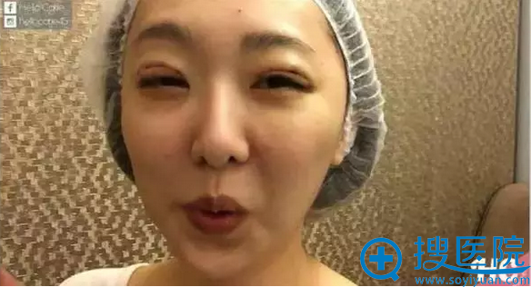 网红直播双眼皮手术天恢复情况 网红直播双眼皮手术天恢复情况