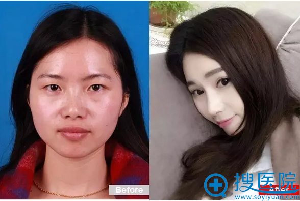 上海华美不对称双眼皮手术前后对比照 上海华美不对称双眼皮手术前后对比照
