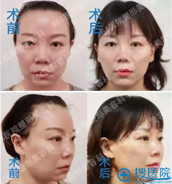 再来看看我做面部线雕提升手术前后对比图 再来看看我做面部线雕提升手术前后对比图