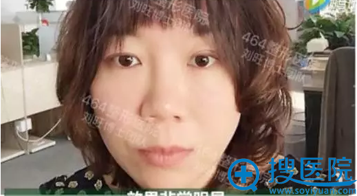 面部线雕提升手术20天了,效果非常显著 面部线雕提升手术20天了,效果非常显著