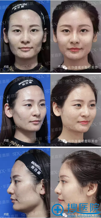 润百颜玻尿酸注射1周了前后对比图 润百颜玻尿酸注射1周了前后对比图