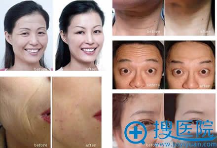 注射瘦脸除皱除皱效果对比图 注射瘦脸除皱除皱效果对比图