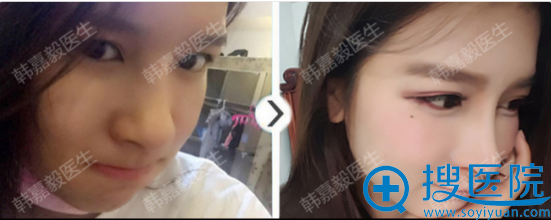 韩嘉毅鼻中隔+硅胶假体手术前后对比图 韩嘉毅鼻中隔+硅胶假体手术前后对比图