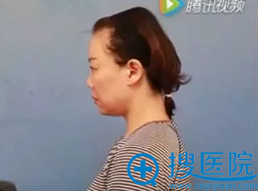 术前侧面照片 术前侧面照片