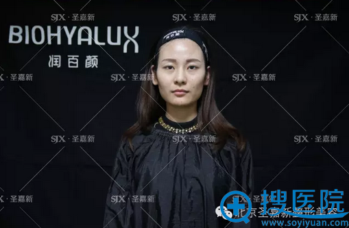 看我在北京圣嘉新整形医院900元注射润百颜玻尿酸过程 维持1年