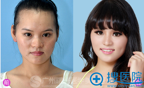 刘杰伟真人隆鼻案例前后对比照 刘杰伟真人隆鼻案例前后对比照