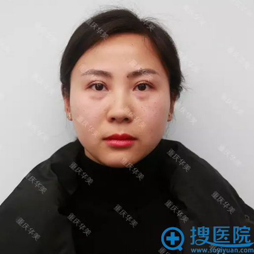 在重庆华美整形医院做激光无痕祛眼袋10天 看我的恢复照怎么样