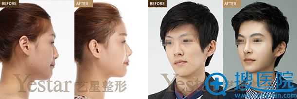 西安艺星整形医院成功案例图 西安艺星整形医院成功案例图