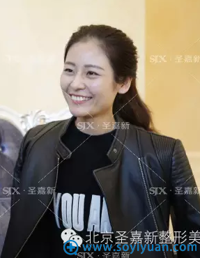 润百颜玻尿酸术后即刻效果 润百颜玻尿酸术后即刻效果