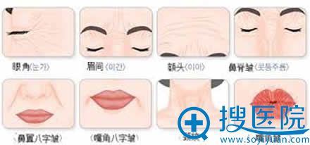 瘦脸除皱适用范围 瘦脸除皱适用范围