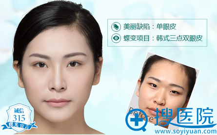 广州曙光双眼皮案例展示图 广州曙光双眼皮案例展示图