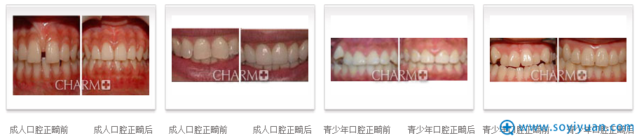 重庆当代牙齿矫正案例 重庆当代牙齿矫正案例