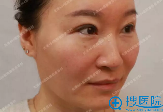 看我在天津464整形医院美容科找许进前做完热拉提效果怎么样